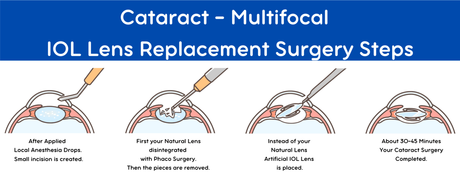 Best Lens for Cataract Surgery – How to Choose Wisely