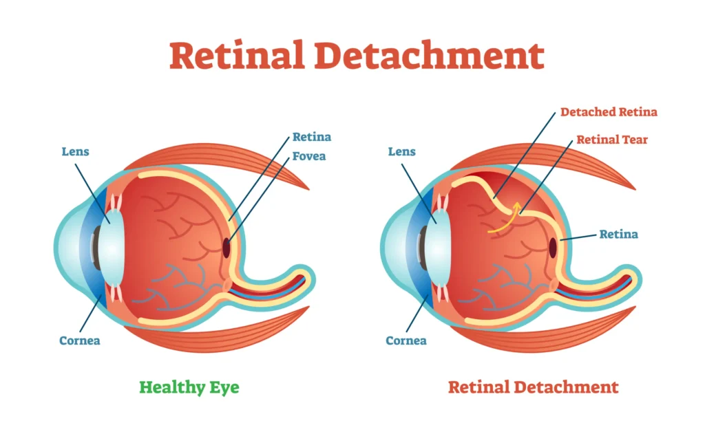 Retinal detachment symptoms