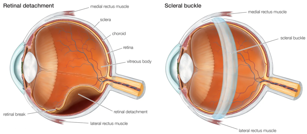 Retinal detachment symptoms