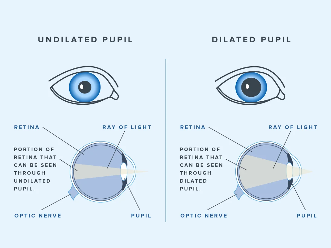 chart of dilated eyes