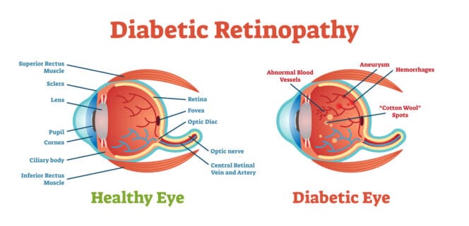 Understanding Diabetic Retinopathy: Prevention, Symptoms, and Treatment Options