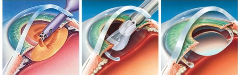 Cataract Surgery in Delhi