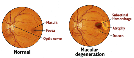 Understanding Macular Degeneration and Its Impact on Vision