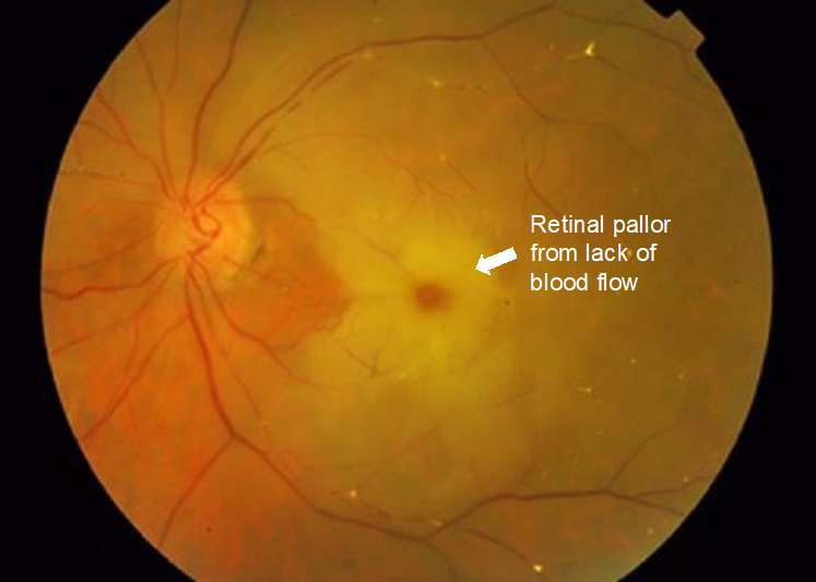 Retinal diseases