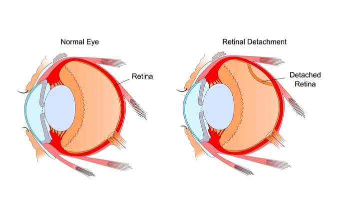 Retinal Surgery