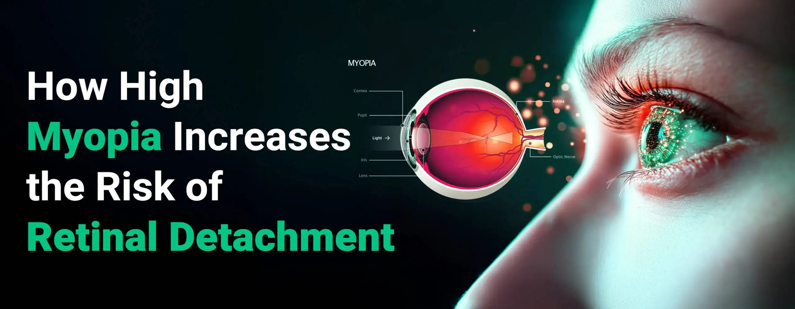 Risk of Retinal Detachment