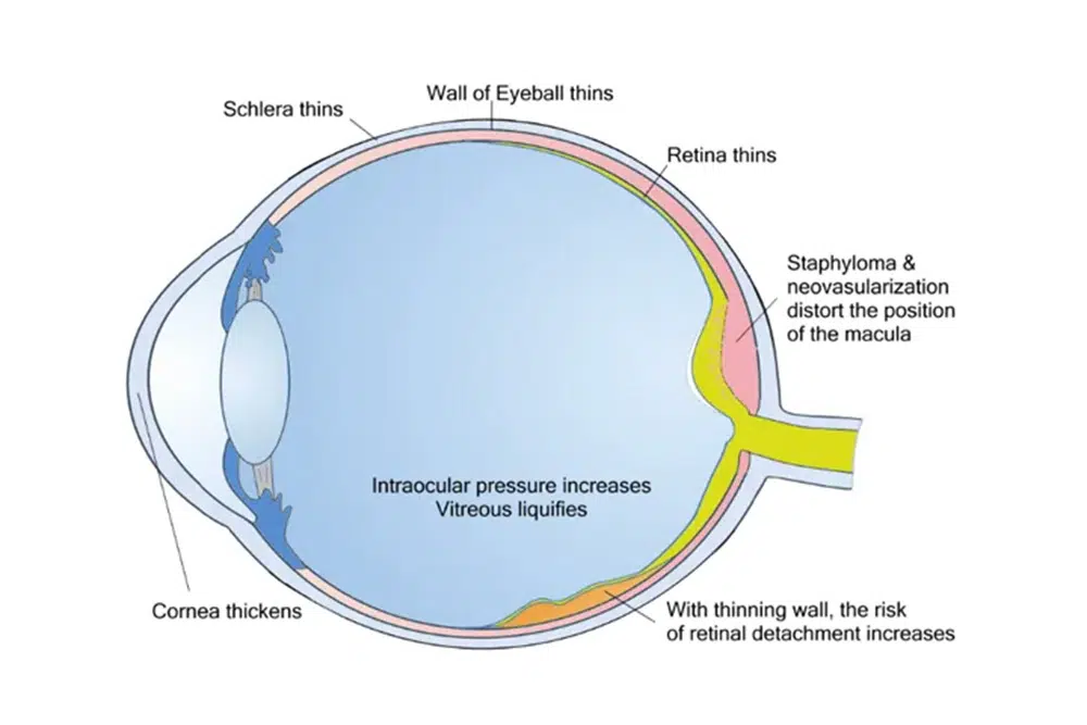 the risk of retinal detachment