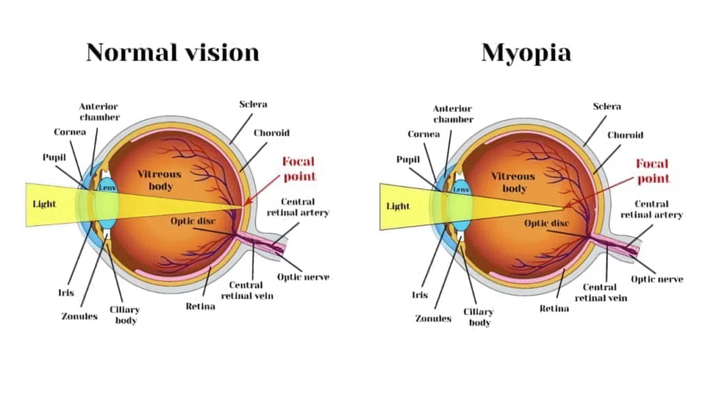 THE RISK of retinal detachment