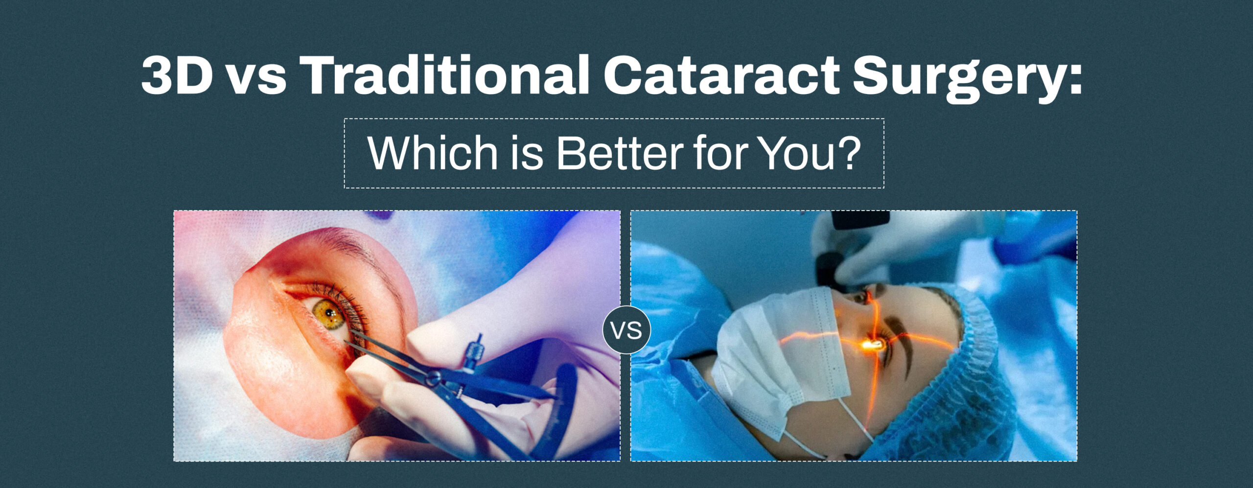 3D vs Traditional Cataract Surgery