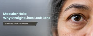 Macular Hole Why Straight Lines Look Bent, or Faces Look Distorted
