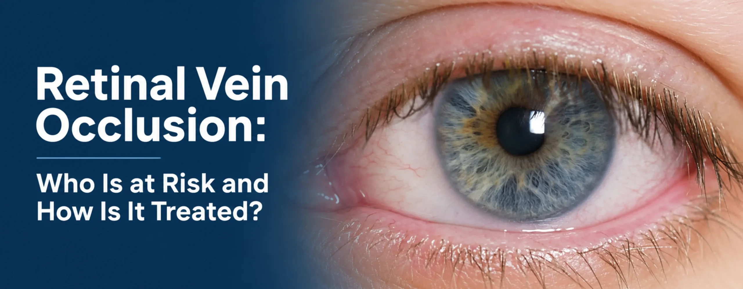 Retinal Vein Occlusion: Who Is at Risk and How Is It Treated?